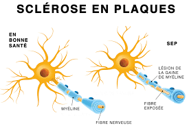 FLD - Sclérose en plaques