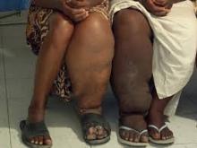 chaussures therapeutiques elephantiasis